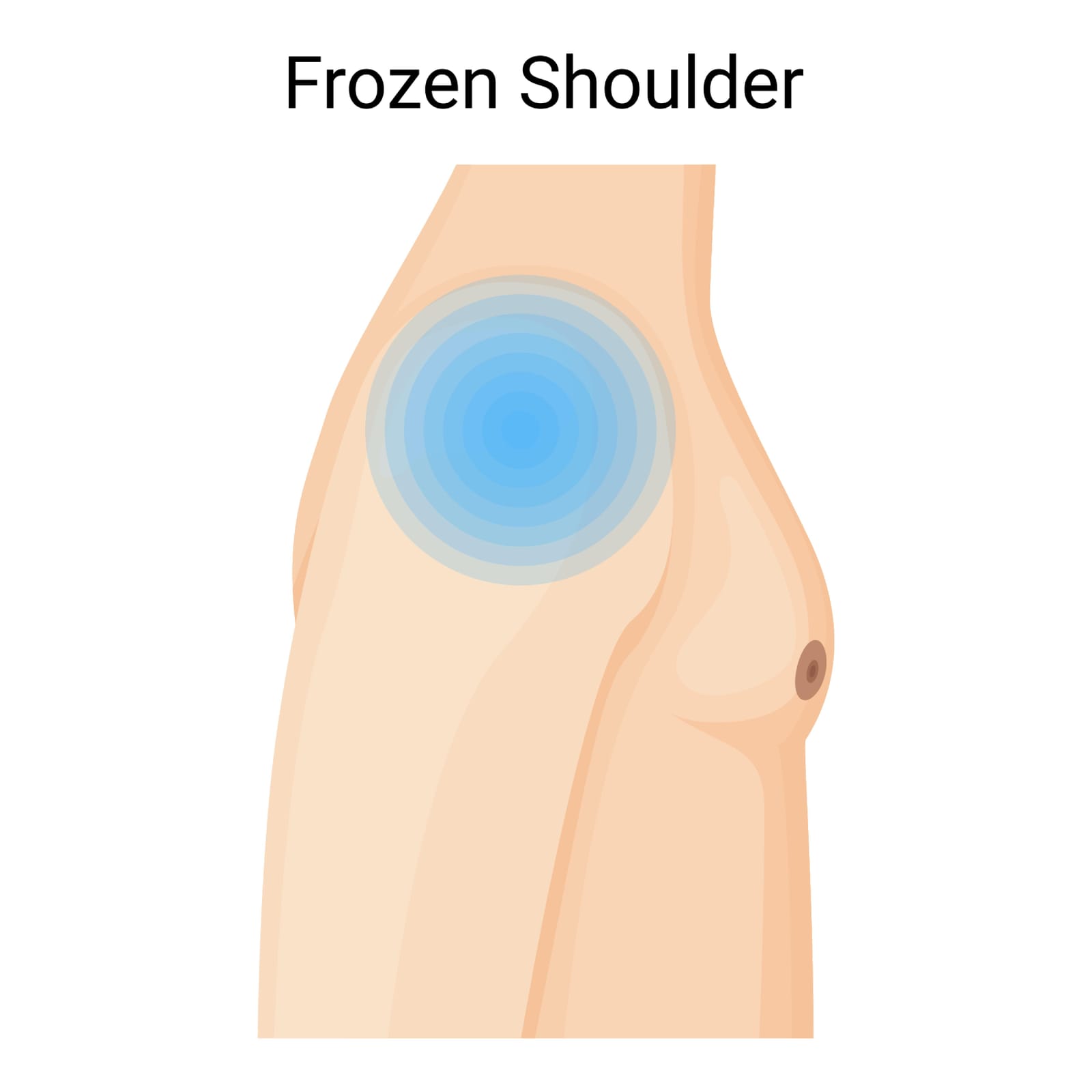 Understanding Frozen Shoulder and Adhesive Capsulitis